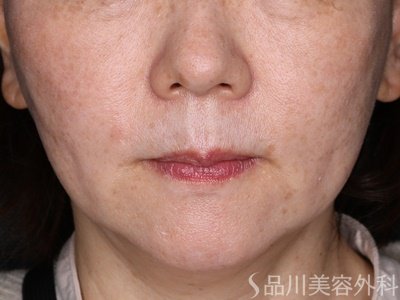 症例NO.72911のAFTER写真