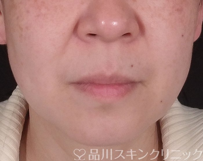 症例NO.70060のBEFORE写真