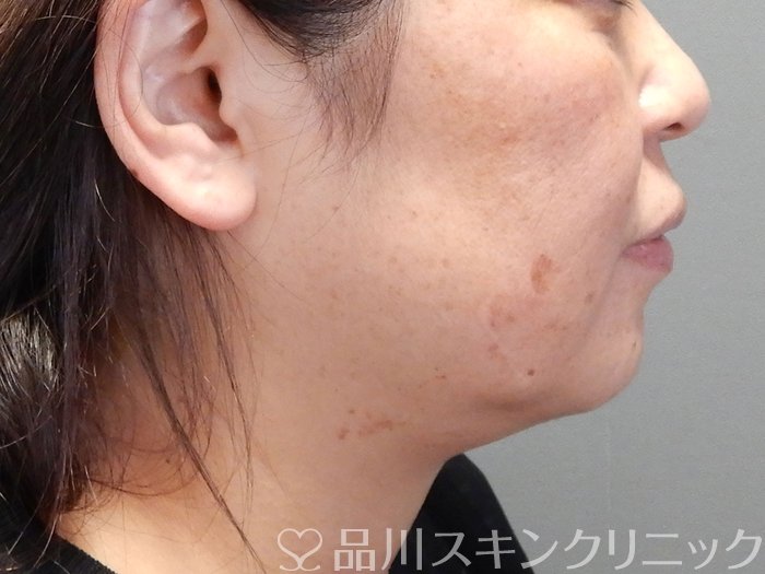 症例NO.69191のBEFORE写真