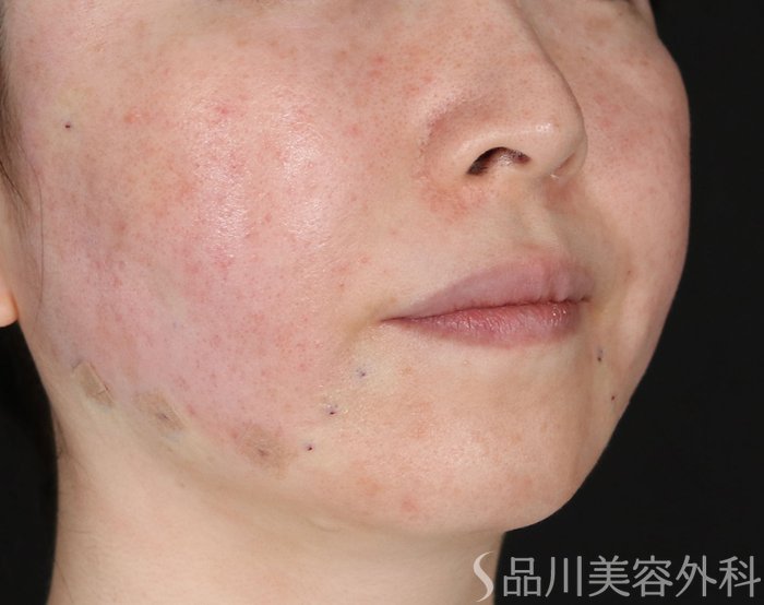 症例NO.72687のAFTER写真