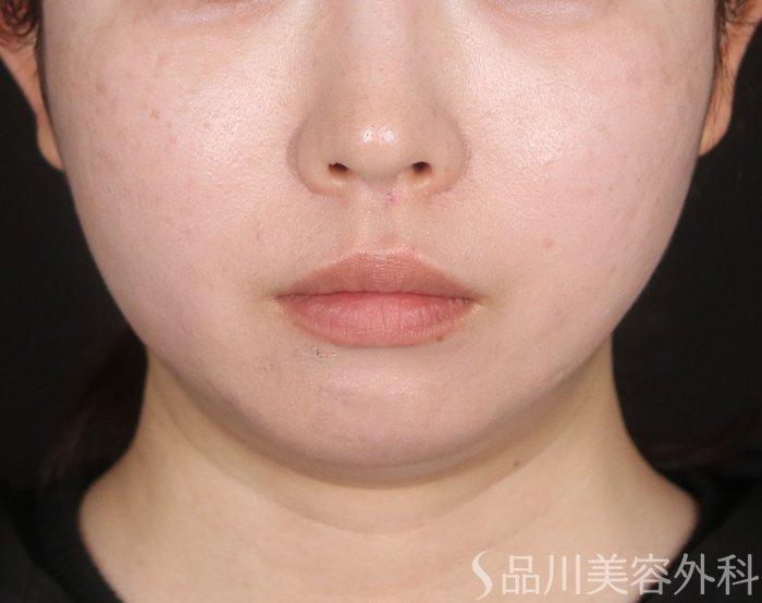 症例NO.73238のAFTER写真