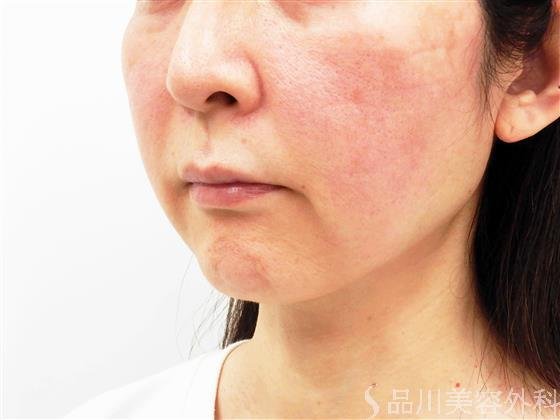 症例NO.57018のBEFORE写真