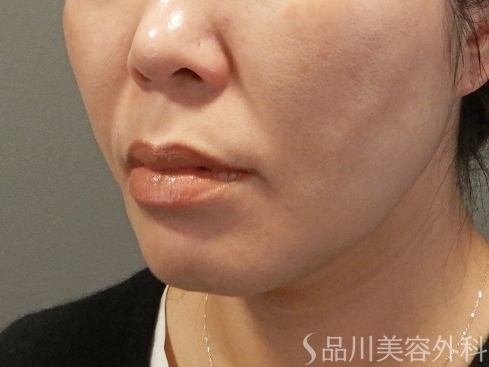 症例NO.69598のAFTER写真