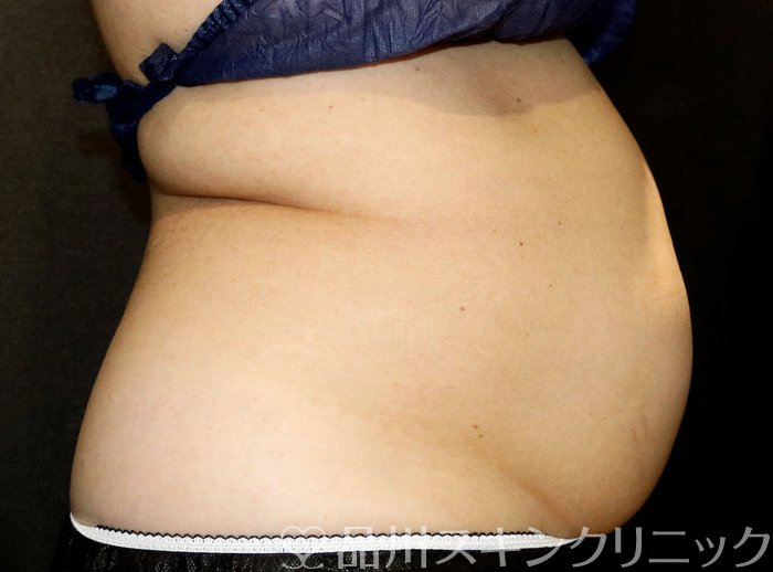 症例NO.72348のAFTER写真