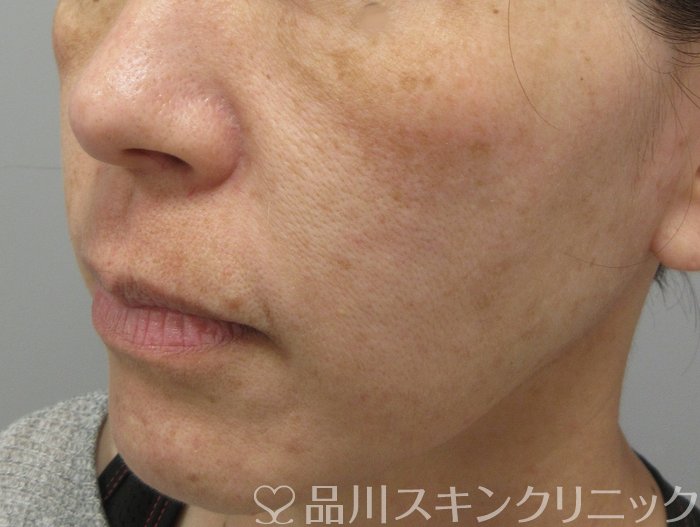 症例NO.70671のBEFORE写真