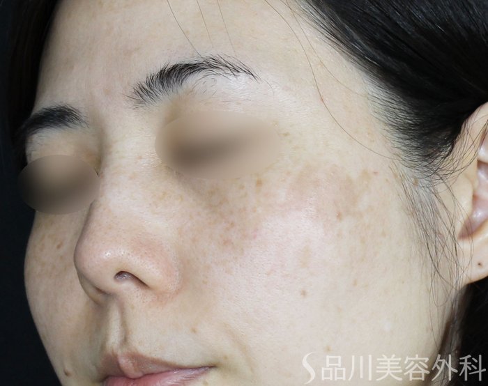 症例NO.65148のBEFORE写真