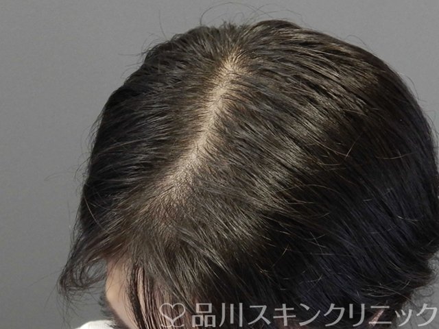 症例NO.69113のBEFORE写真
