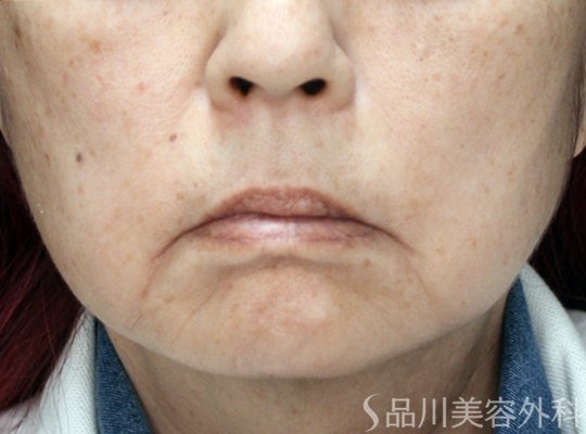 症例NO.70347のBEFORE写真