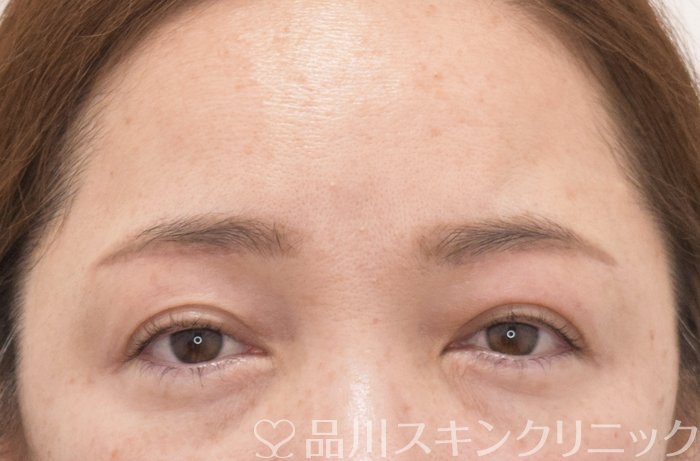 症例NO.73993のAFTER写真
