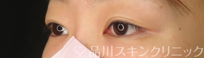 症例NO.65857のBEFORE写真