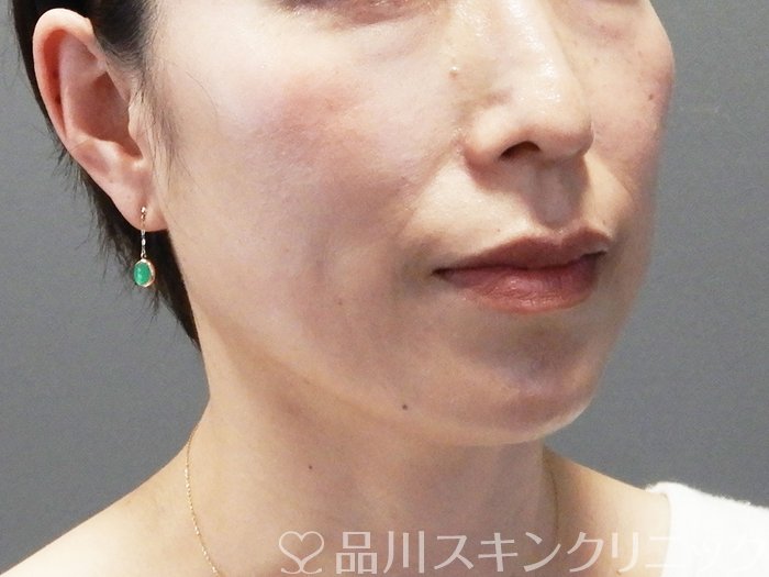 症例NO.74357のBEFORE写真