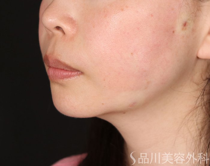 症例NO.74044のAFTER写真