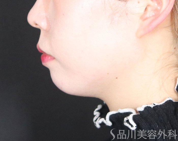 症例NO.72996のBEFORE写真