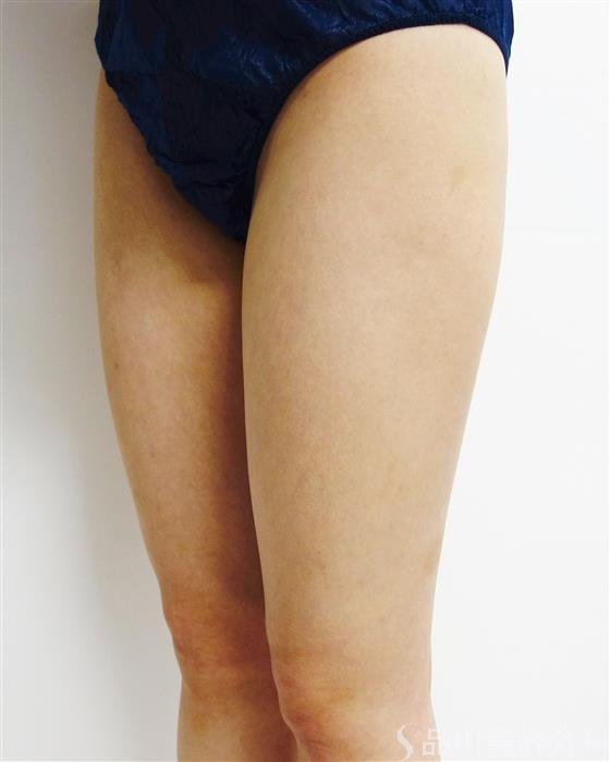 症例NO.50701のAFTER写真