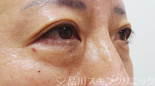 症例NO.66606のBEFORE写真
