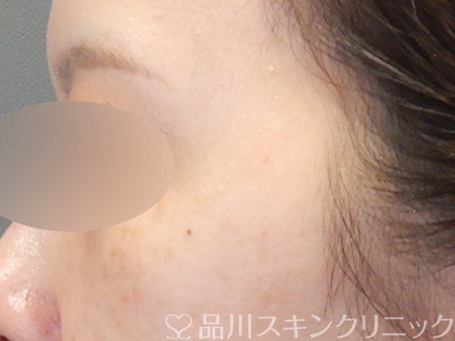 症例NO.68612のAFTER写真