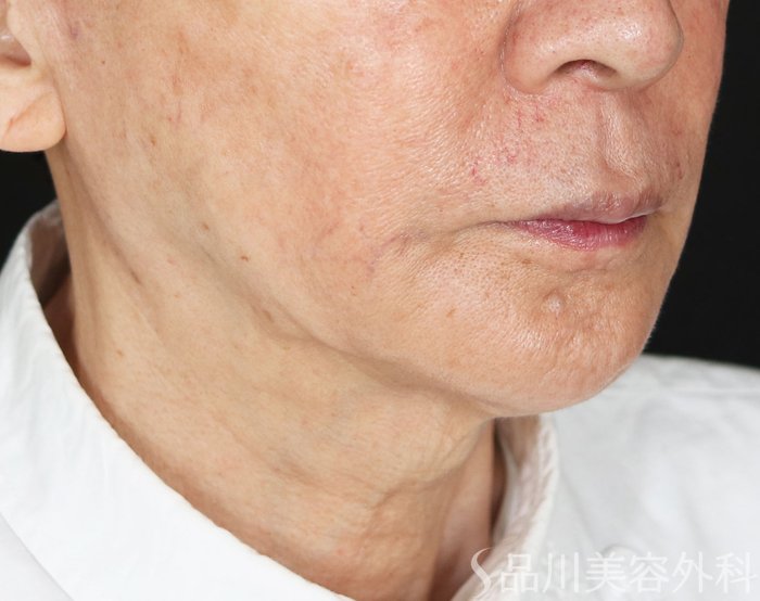 症例NO.73902のAFTER写真