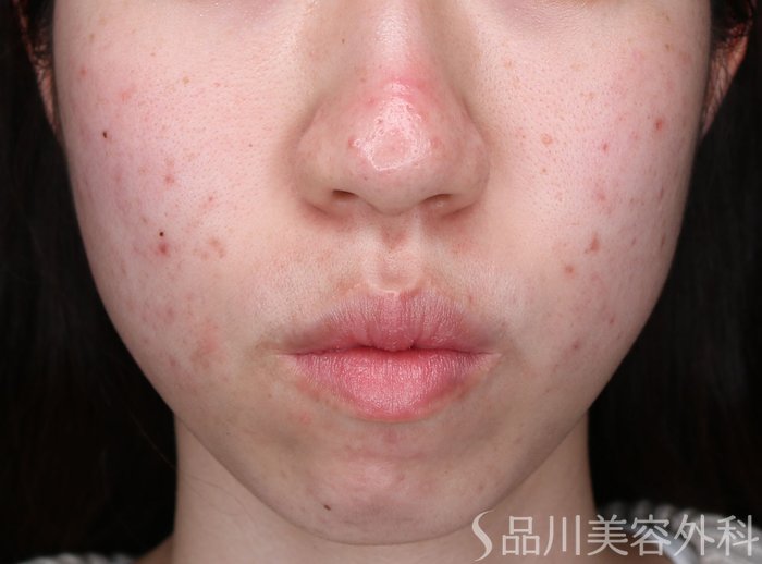 症例NO.73511のBEFORE写真