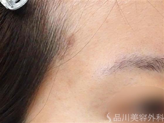 症例NO.57538のAFTER写真