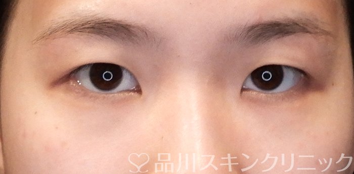 症例NO.65026のBEFORE写真