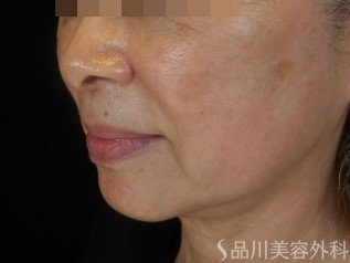 症例NO.74538のBEFORE写真