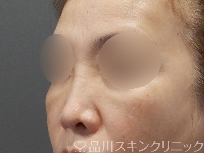 症例NO.75044のBEFORE写真