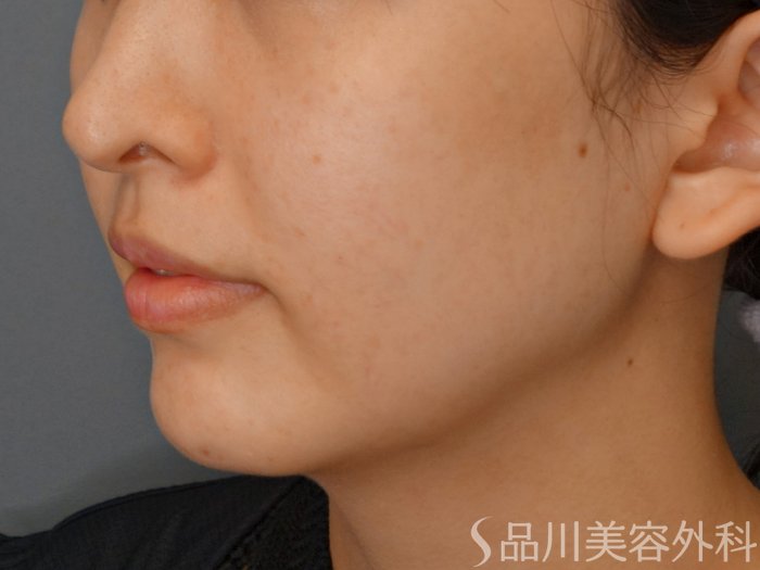 症例NO.73712のBEFORE写真