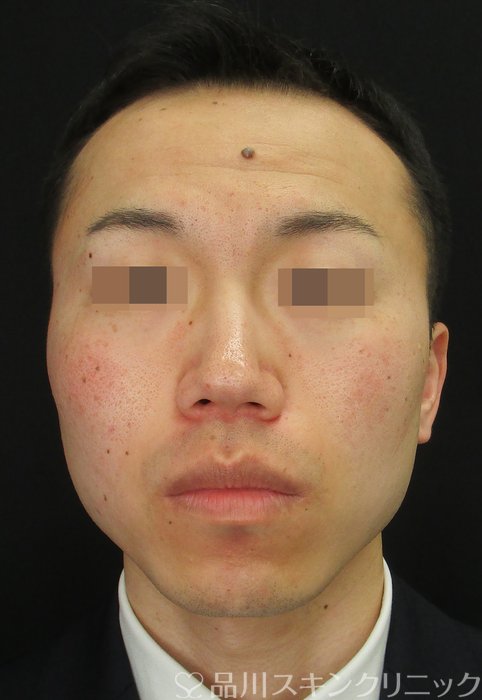 症例NO.74172のBEFORE写真
