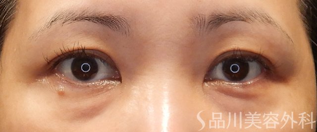 症例NO.72121のBEFORE写真