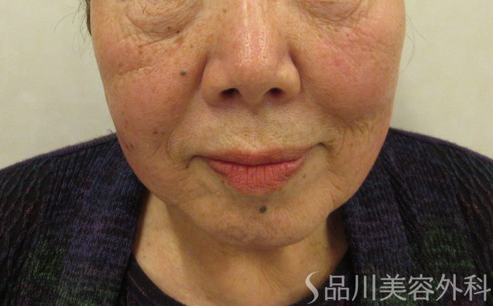 症例NO.73659のBEFORE写真