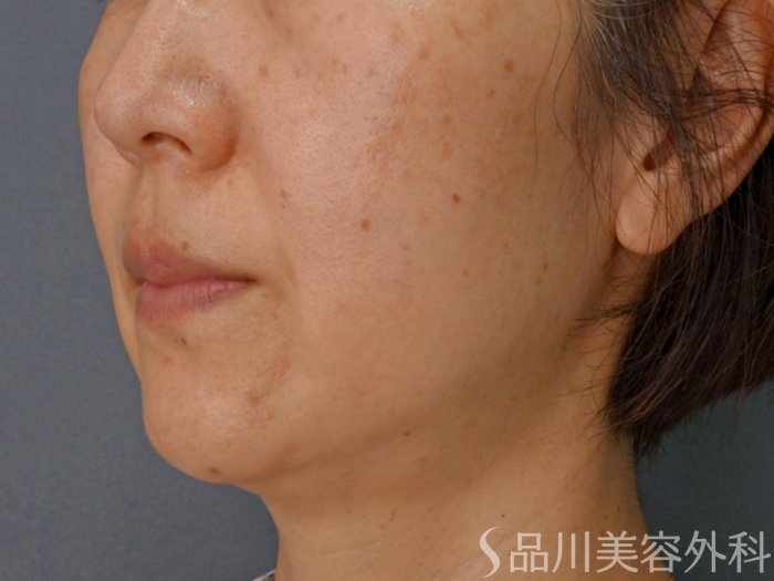 症例NO.74231のBEFORE写真