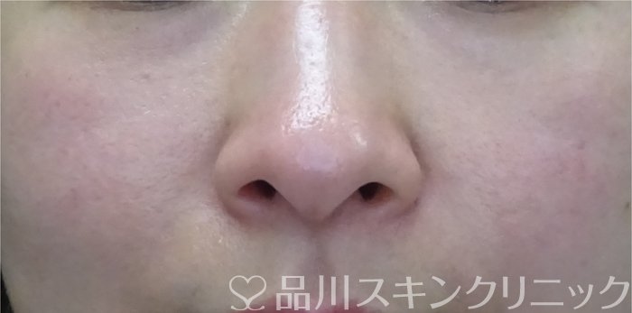 症例NO.69327のBEFORE写真