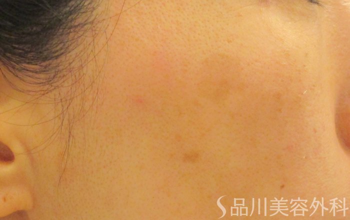 症例NO.65374のAFTER写真