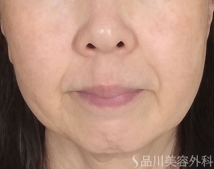 症例NO.65136のBEFORE写真