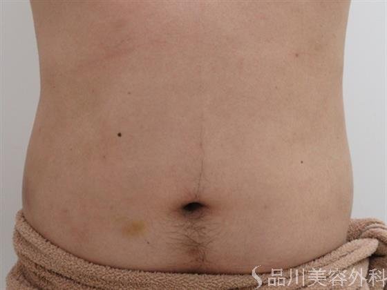 症例NO.26106のAFTER写真