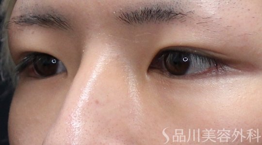 症例NO.75213のBEFORE写真