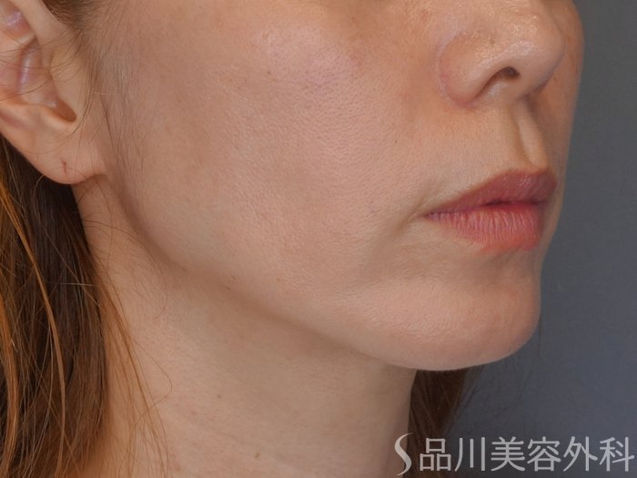 症例NO.72119のAFTER写真