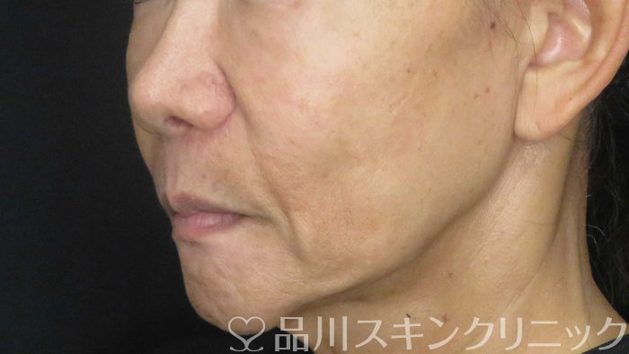 症例NO.71467のBEFORE写真