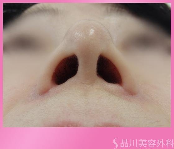 症例NO.1242のAFTER写真