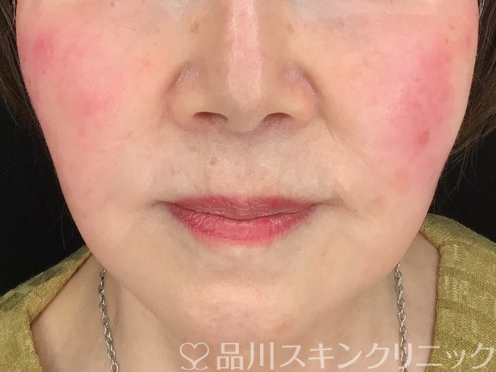 症例NO.64960のBEFORE写真