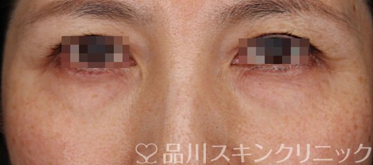 症例NO.64149のBEFORE写真