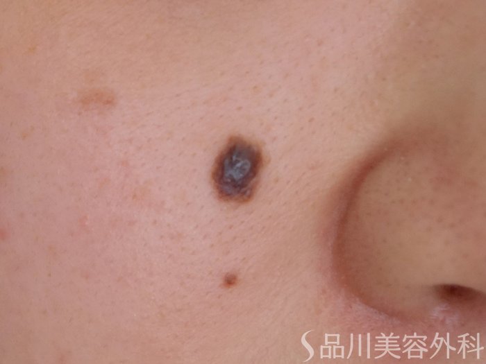 症例NO.70102のBEFORE写真