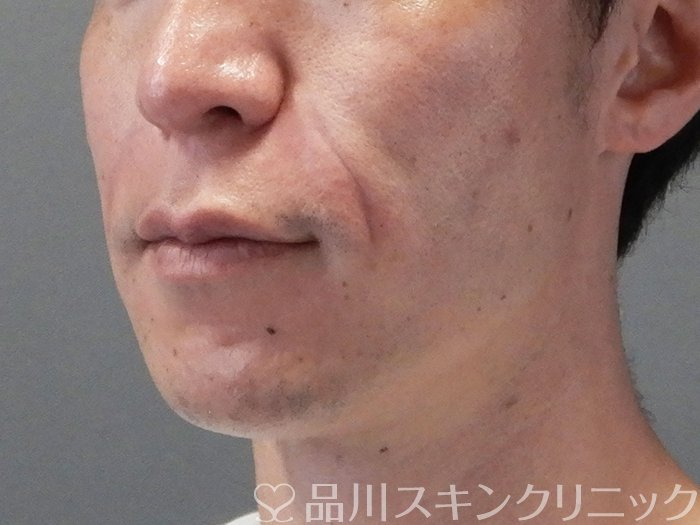 症例NO.70689のAFTER写真
