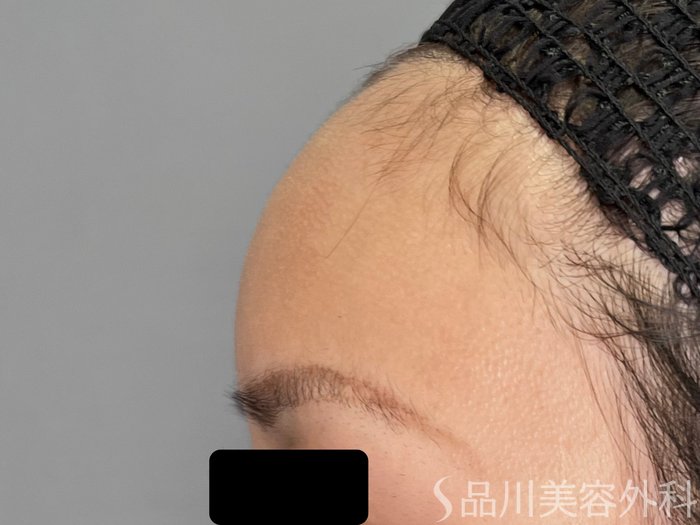 症例NO.70656のAFTER写真