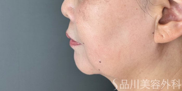 症例NO.71783のBEFORE写真