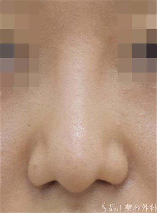 症例NO.52915のAFTER写真
