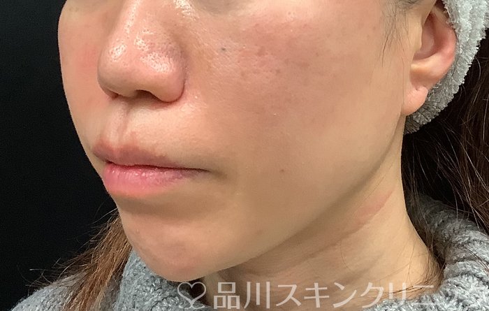 症例NO.69065のBEFORE写真