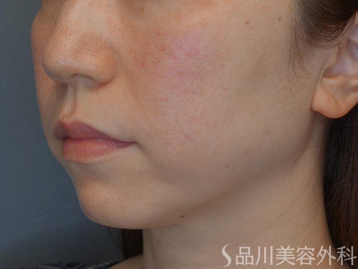 症例NO.73854のBEFORE写真