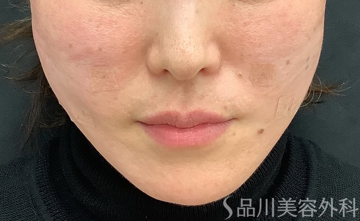 症例NO.69484のAFTER写真