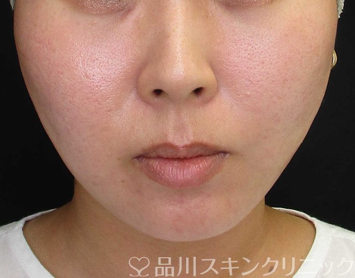 症例NO.67851のAFTER写真